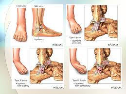 Likely to be caused by a fatigue tear in the medial capsular insertion into the patella (dutton). The Ankle And Foot Joints Ppt Download