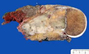 Image result for Osteosarcoma