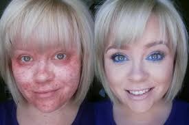 Hailey Bieber showed off her toned abs in a chic crop top just days after  revealing a perioral dermatitis flare-up.