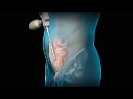 Total Extraperitoneal Tep Laparoscopic Inguinal Hernia Repair Hernia Repair Abdominal Hernia Umbilical Hernia Repair
