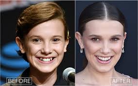 Celebrities in braces…before & after!!! Celebrities Cosmetic Dentistry Teeth Before And After