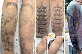 Thankfully we utilize multiple wavelengths here at river city laser removal , so you can be confident that we will achieve optimal removal results. Picosure Tattoo Removal 3 Sessions