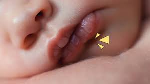 Maybe you would like to learn more about one of these? Penyebab Bibir Bayi Kering Dan Pecah Pecah Saat Baru Lahir Orami