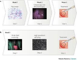 How is vulvar cancer diagnosed? Optical Imaging For Cervical Cancer Detection Solutions For A Continuing Global Problem Nature Reviews Cancer