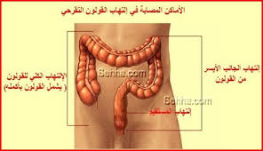 أعراض التهاب القولون التقرحي
