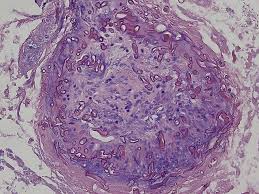 Russian medical academy of here, the drugs most commonly used in treatment of acute cough during acute respiratory viral infections. What Is Mucormycosis Centre Warns That It May Turn Fatal If Uncared For All You Need To Know