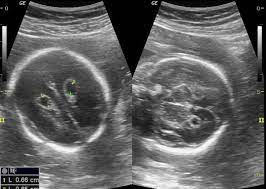 Choroid Plexus Cyst Radiology Case Radiopaedia Org
