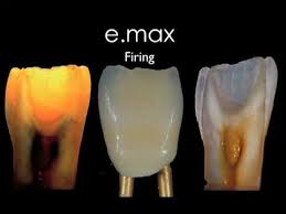 E Max Ceram Porcelain Build Up Smiledesign