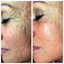 Select from premium vorher nachher images of the highest quality. Mezotix Bei Naturkosmetik Susanne Kaussen Vormals Naturkosmetik Kleve Susanne Kaussen
