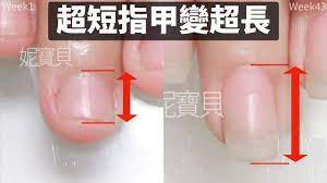 超短指甲變超長 宜蘭高中生 摳咬指甲甲床外露甲床內陷指肉外露 nails