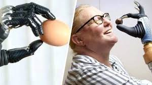 แขนกลจากอิตาลี ผลิต "Mia Hand" มือเทียม  ที่สามารถเชื่อมต่อกระดูกและระบบประสาทได้ เป็นชิ้นแรกของโลก!