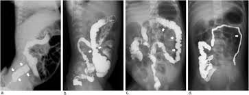 Barium Enema Findings In Total Colonic Aganglionosis A Single Center Retrospective Study Bmc Pediatrics Full Text