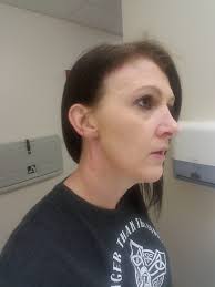 Are botox injections typically administered in the same areas?