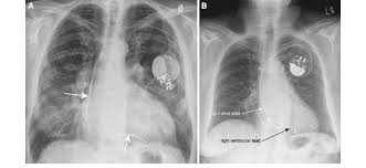 Icds are a separate category and usually not considered pacemakers although they do have a pacing function. Radiographic Appearance Of An Implantable Cardioverterdefibrillator Download Scientific Diagram