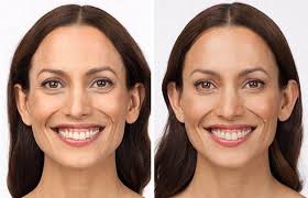 Can smile lines be treated with botox? Botox Seattle Botox Specialist Bellevue