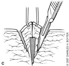 Cactus slivers are food items that are crafted using 2 cactus blocks, and 1 sword of any type. Management Of Foreign Bodies In The Skin American Family Physician