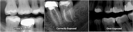 There is also no reason for the patient to gag. Top Dental Digital Radiography Mistakes Dentalsensors Com