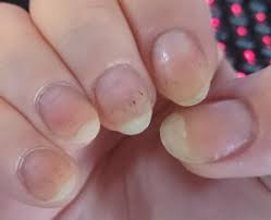ask ana black spots in nails nail