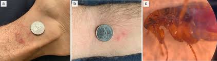 Image result for flea bites