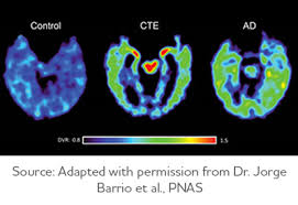 Cte 400 memur alımı için süreç resmen başladı. Chronic Traumatic Encephalopathy Cte Symptoms Treatments Alz Org