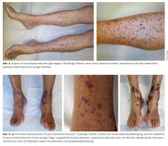 Image result for Vasculitis