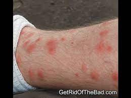 If you find yourself plagues with bug bites that just won't stop itching, give anbesol a try. How To Get Rid Of Chigger Bites And Stop Itching Naturally Youtube