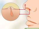 Ingrown Nose Pimple