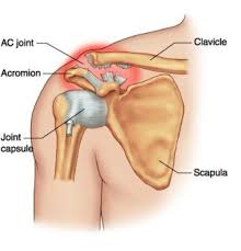 Image result for Shoulder Pain