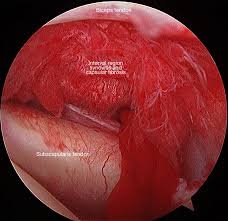 Image result for Frozen Shoulder