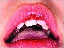 Primary (acute) herpetic gingivostomatitis symptoms. Lip Lesions In Primary Herpetic Gingivostomatitis In A Woman In The Download Scientific Diagram