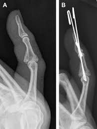 Image result for Volar PIP Dislocation