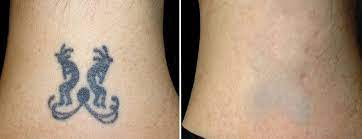 Our lasers are capable of removing all colors of tattoo ink including tough greens and blues. Tattoo Removal Twin Cities All Natural Non Laser Tattoo Removal