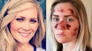 Based on the type and stage of the cancer and other factors, your treatment options may include: Woman Shares Horrifying Photos Of Her Skin Cancer Treatment Wqad Com