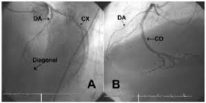Over 99% of people have at least one diagonal branch of the left anterior descending artery. Dual Left Anterior Descending Coronary Artery Type Iv Revista Espanola De Cardiologia