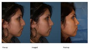 How much is it to get a nose job. Rhinoplasty Chicago Dr George Moynihan Nose Job