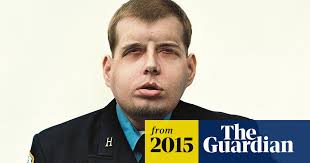 New York plastic surgeon performs 'most extensive' face transplant ever