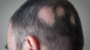 Natural Treatments For Alopecia Areata