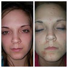 I was still skeptical as i am when something seems too good to be true. Adapalene Topical Retinoid Acne Treatment Differin Gel