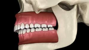 Causes, complications & how to fix them. What Is An Overbite And How To Correct It Jefferson Dental Orthodontics