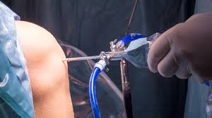 Operatia la genunchi nu este grea. Artroscopia De Genunchi Ortopedia Pe InÅ£elesul Tuturor