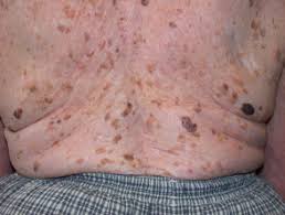 We did not find results for: Seborrhoeic Keratosis Dermnet Nz