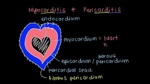 Children with suspected myocarditis or pericarditis should be sent to an emergency department, where access to specialists with expertise in these diseases is available. What Is Myocarditis And Pericarditis Youtube