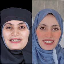 My comprehensive care case ( CCC ) وَقُلِ ٱعْمَلُواْ فَسَيَرَى ٱللَّهُ  عَمَلَكُمْ وَرَسُولُهُۥ وَٱلْمُؤْمِنُونَ ۖ Done with my favorite partner  out there Roma Muhammad♥️👩🏻‍⚕️ Special thanks to dr Sherif Abdel Hamid ♥️