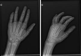 Image result for Pisiform Bone