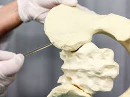 Your bone metastases may be: Bone Marrow Aspiration Purpose Procedure Risks