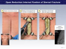 Image result for Sternal Fracture