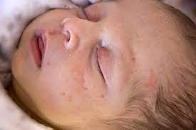 Hives is usually triggered by something, like an allergic. Baby Acne Causes Diagnosis And Treatment