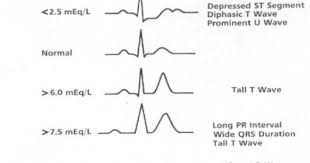 Hypopotassemia Ekg Google Search Hyperkalemia Heart Treatment Pr Interval