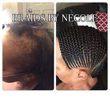 14 Extraordinary Alopecia Camouflage Cornrows By Braids By Necole Alopecia Hairstyles African Braids Hairstyles Cornrows Braids For Black Women