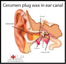Cerumen Plug Wax In Ear Canal Colon Cleanse Cleaning Your Ears Colon Cleanse Diet